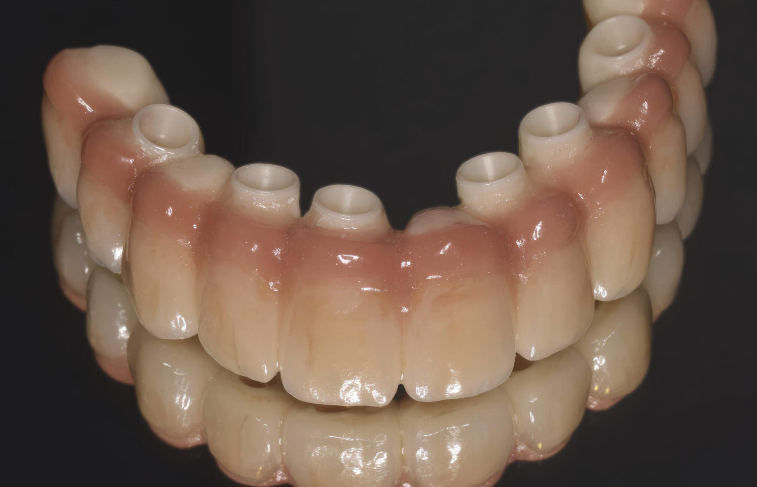 Barra implantosa CAD:CAM en resina con encía artificial – Prótesis estabilizada sobre implantes