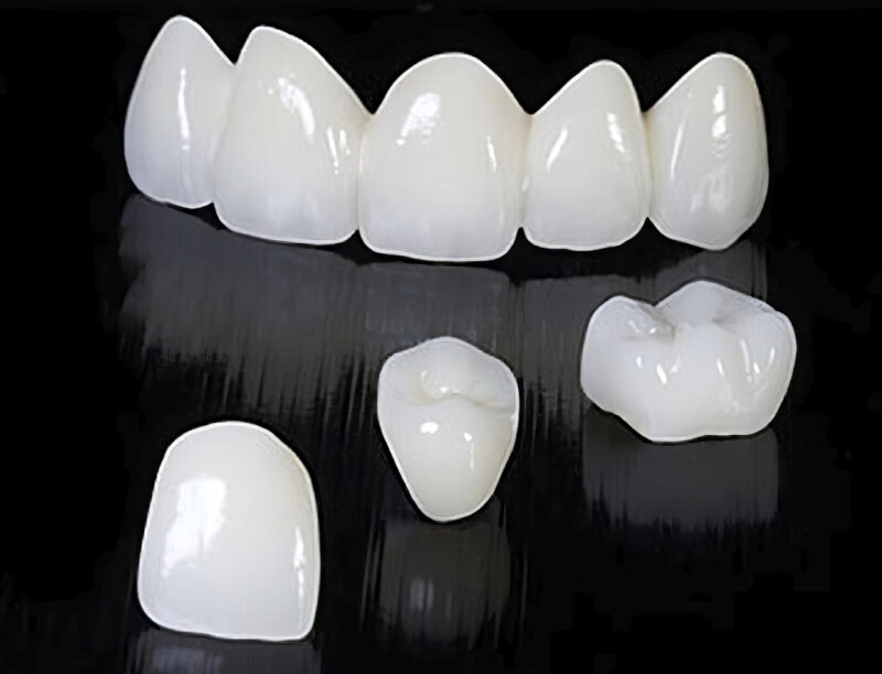 Corona Full Zirconia Multicapa – Prótesis dental 100% zirconia, translúcida y resistente, para una restauración duradera y estética 2