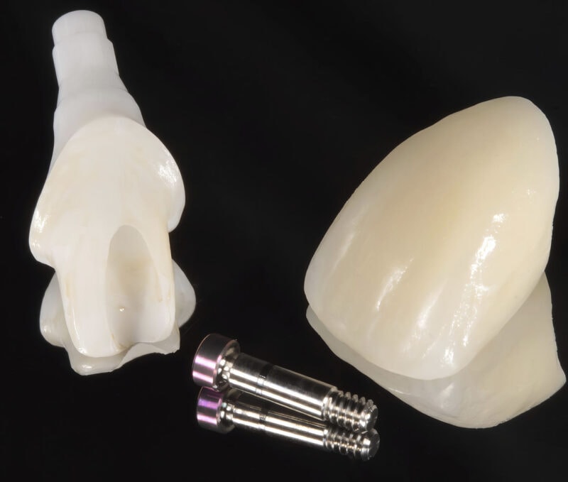 Corona cementada sobre implante con pilar de titanio – restauración unitaria estética