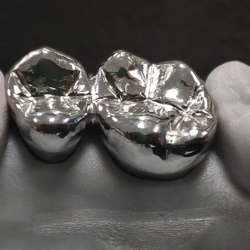 Corona colada – Prótesis dental fija económica y robusta para restaurar de forma duradera los dientes dañados