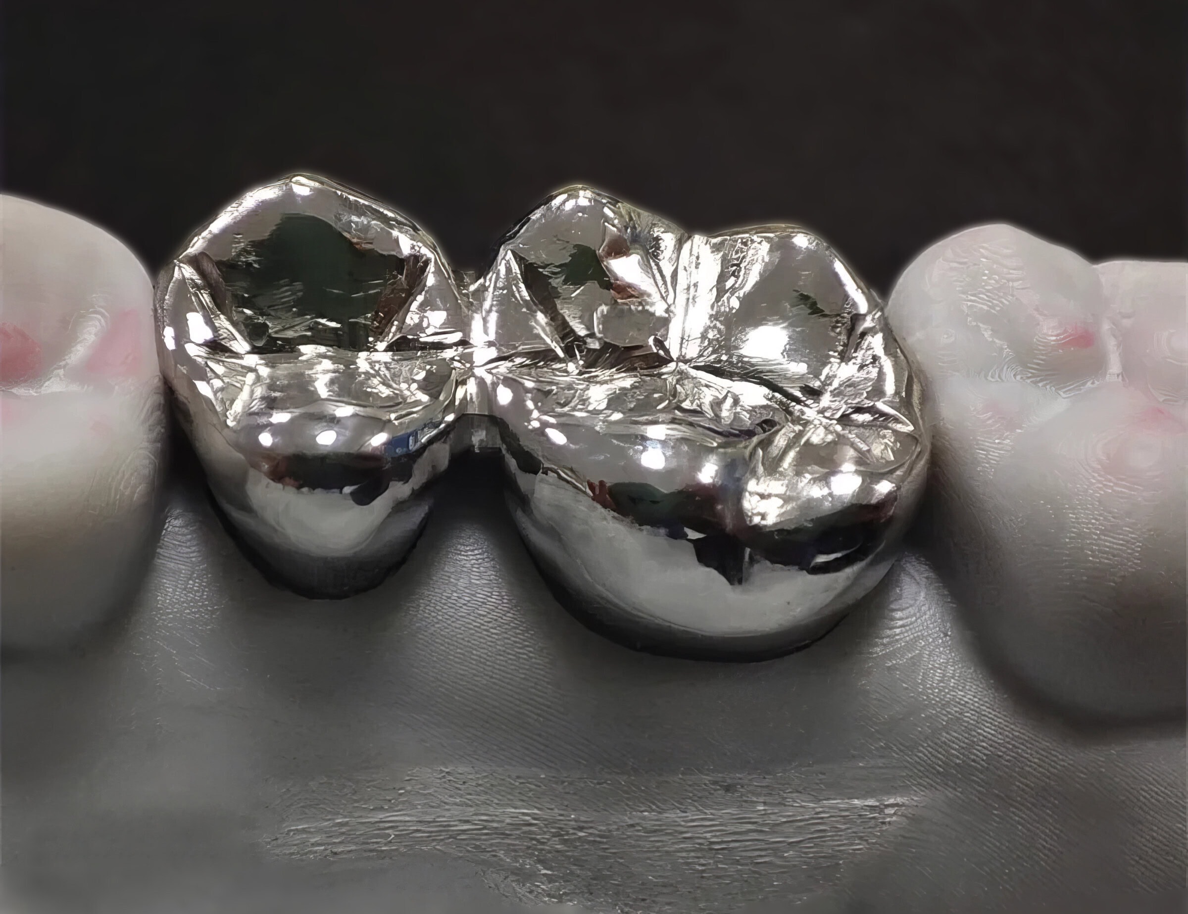 Corona colada – Prótesis dental fija económica y robusta para restaurar de forma duradera los dientes dañados
