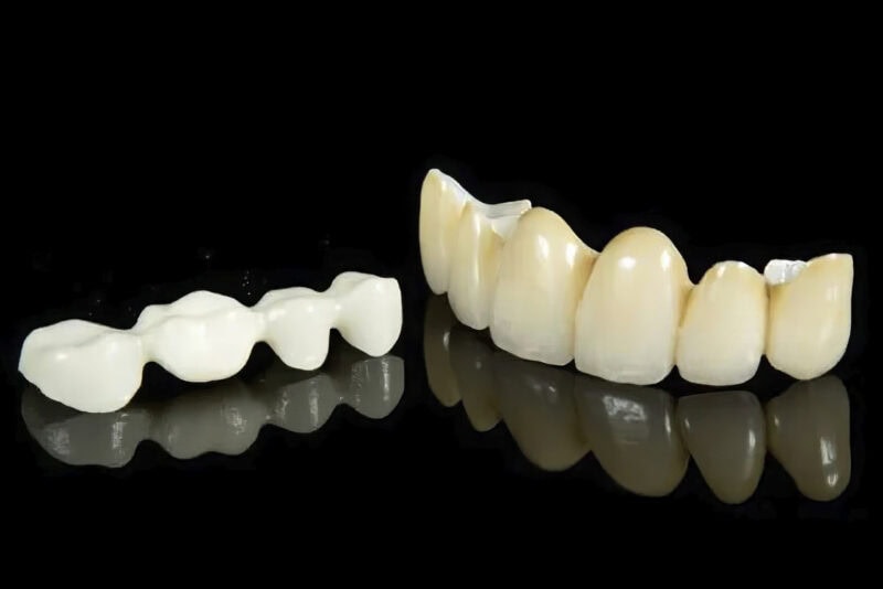 Corona de zirconia estratificada — Prótesis dental de alta gama que combina estructura de zirconia y estratificación cerámica para un resultado natural y duradero 1