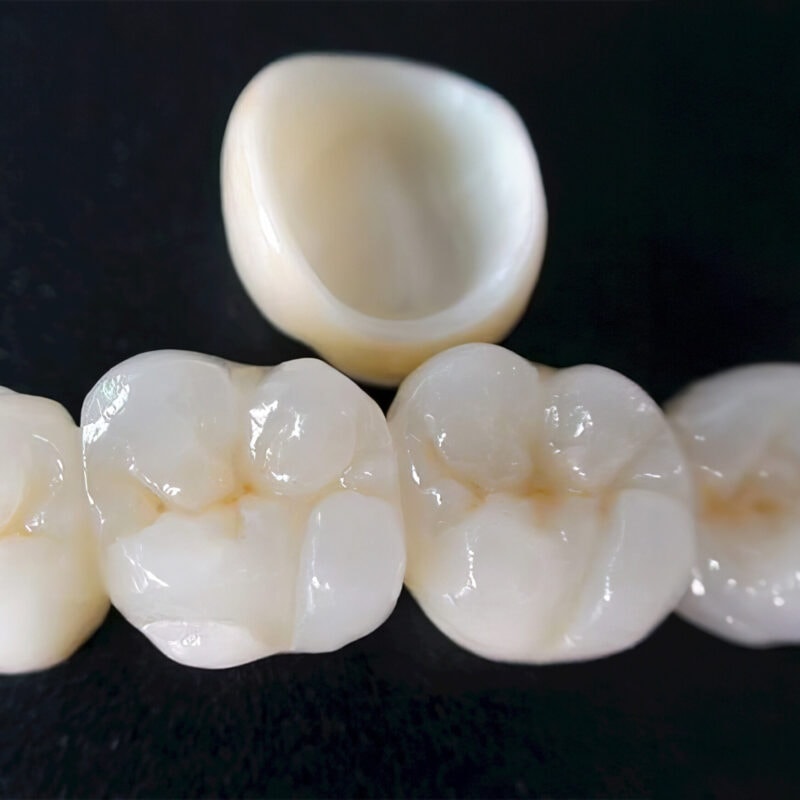 Corona de zirconia estratificada — Prótesis dental de alta gama que combina estructura de zirconia y estratificación cerámica para un resultado natural y duradero 2