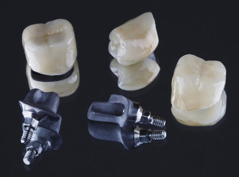 Coronas dentales cementadas y pilares personalizados para implantes – ajuste preciso y diseño natural