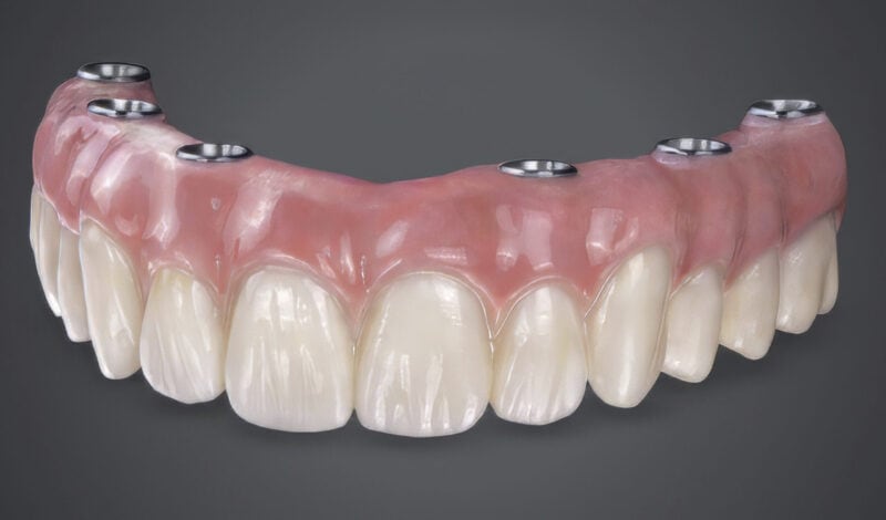 Ejemplo de restauración All On sobre implantes con encía artificial rosa y dientes de resina de alta calidad
