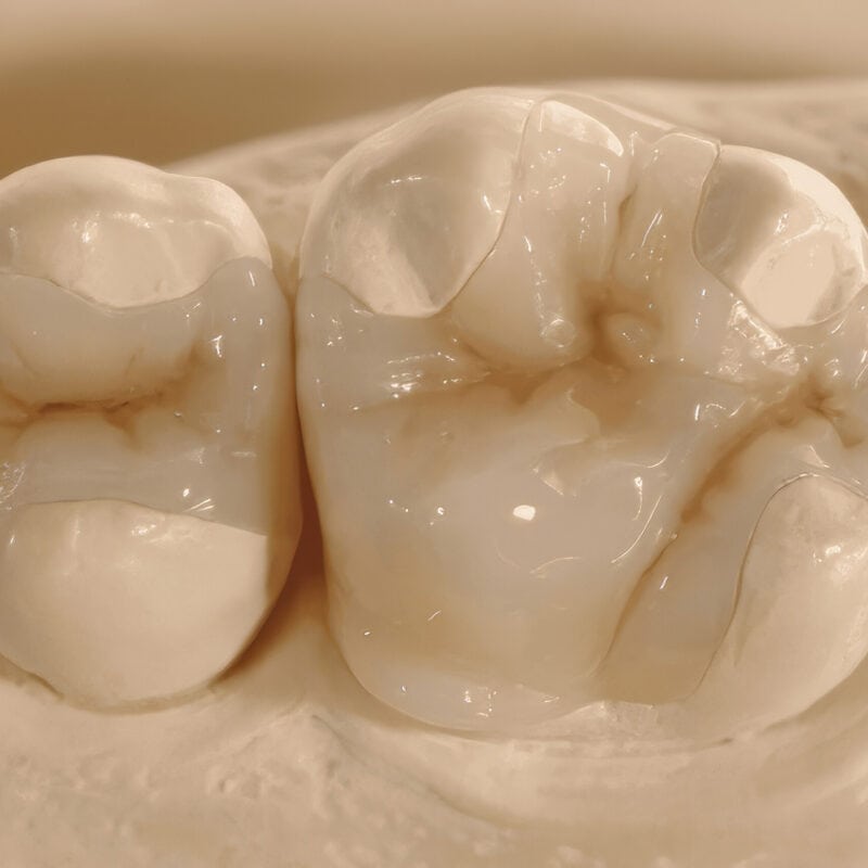 Inlay Onlay composite – Solución estética y duradera para restaurar la dentición, alternativa moderna a las obturaciones tradicionales 2