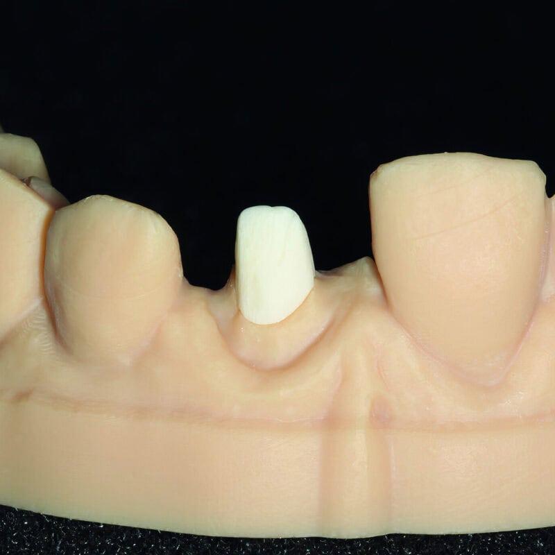 Inlay-core de fibra de vidrio – Solución innovadora para una restauración dental resistente, estética y biocompatible 1
