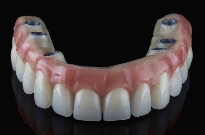 Prótesis completa sobre implantes All On con estructura de titanio y cosmética acrílica