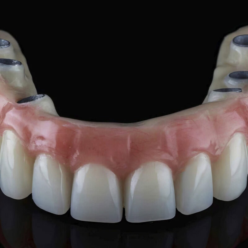 Prótesis completa sobre implantes All On con estructura de titanio y cosmética acrílica