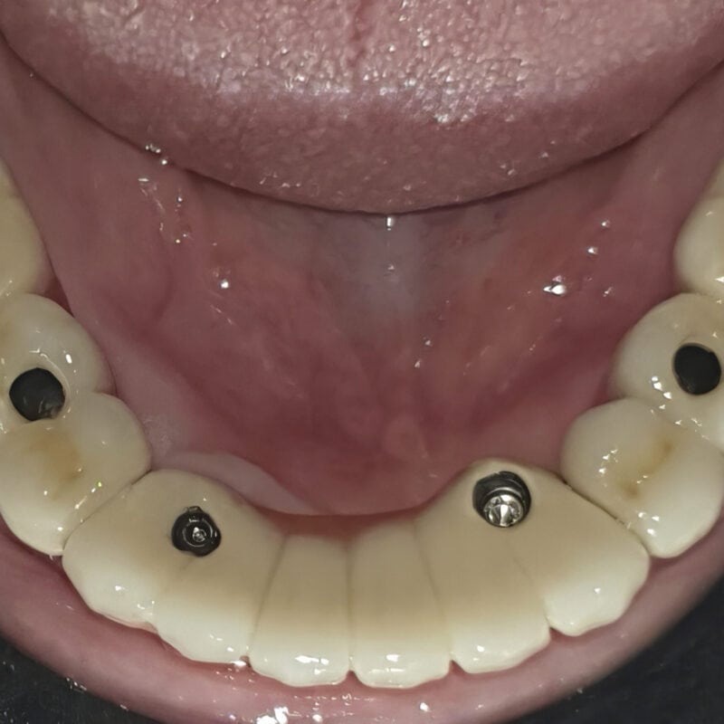 Puente completo atornillado sobre implantes multi-unit – accesos oclusales visibles para atornillado:desatornillado fácil